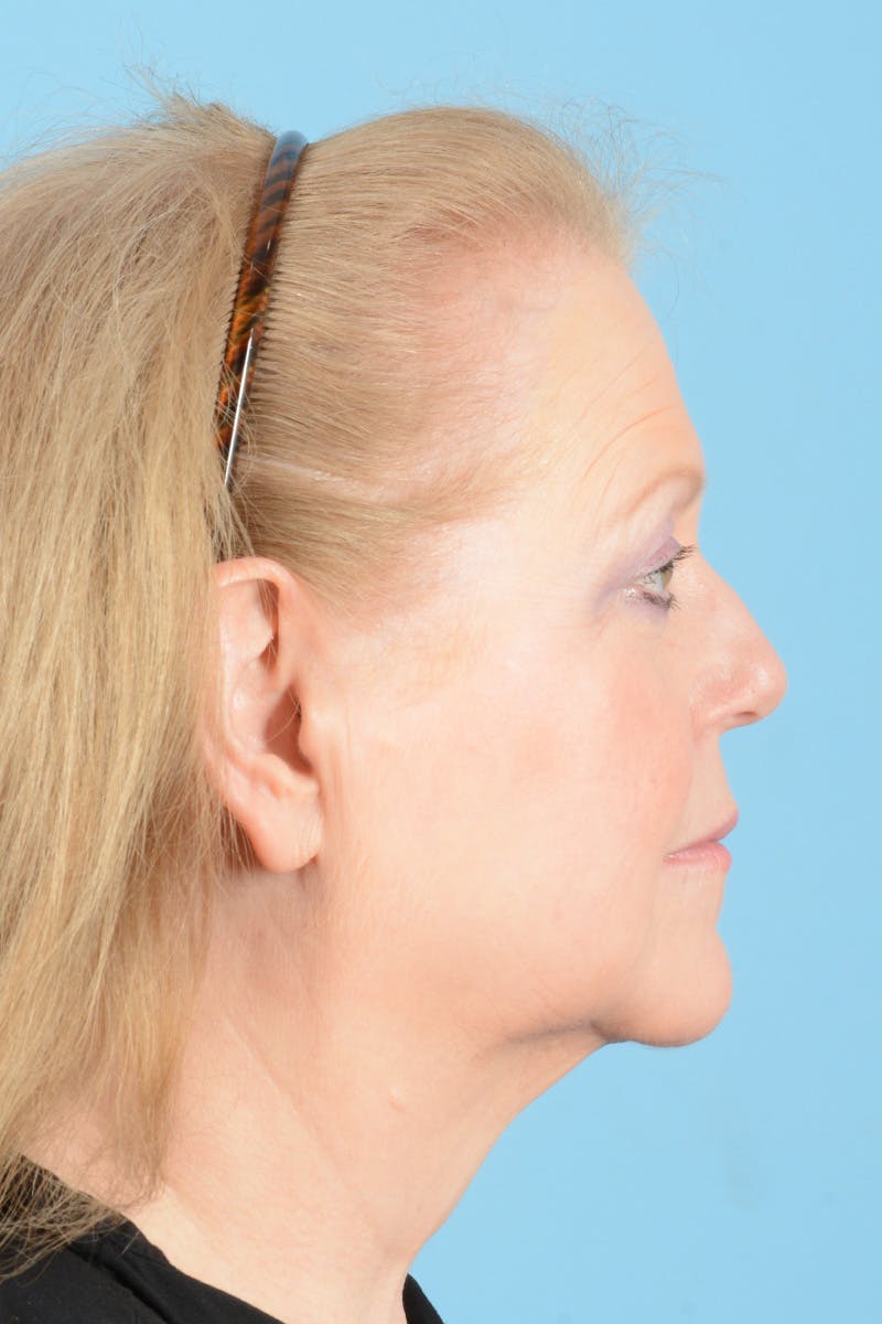 Facelift Before & After Gallery - Patient 422480 - Image 9