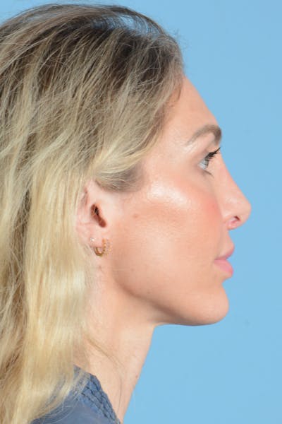 Rhinoplasty Before & After Gallery - Patient 249686 - Image 8