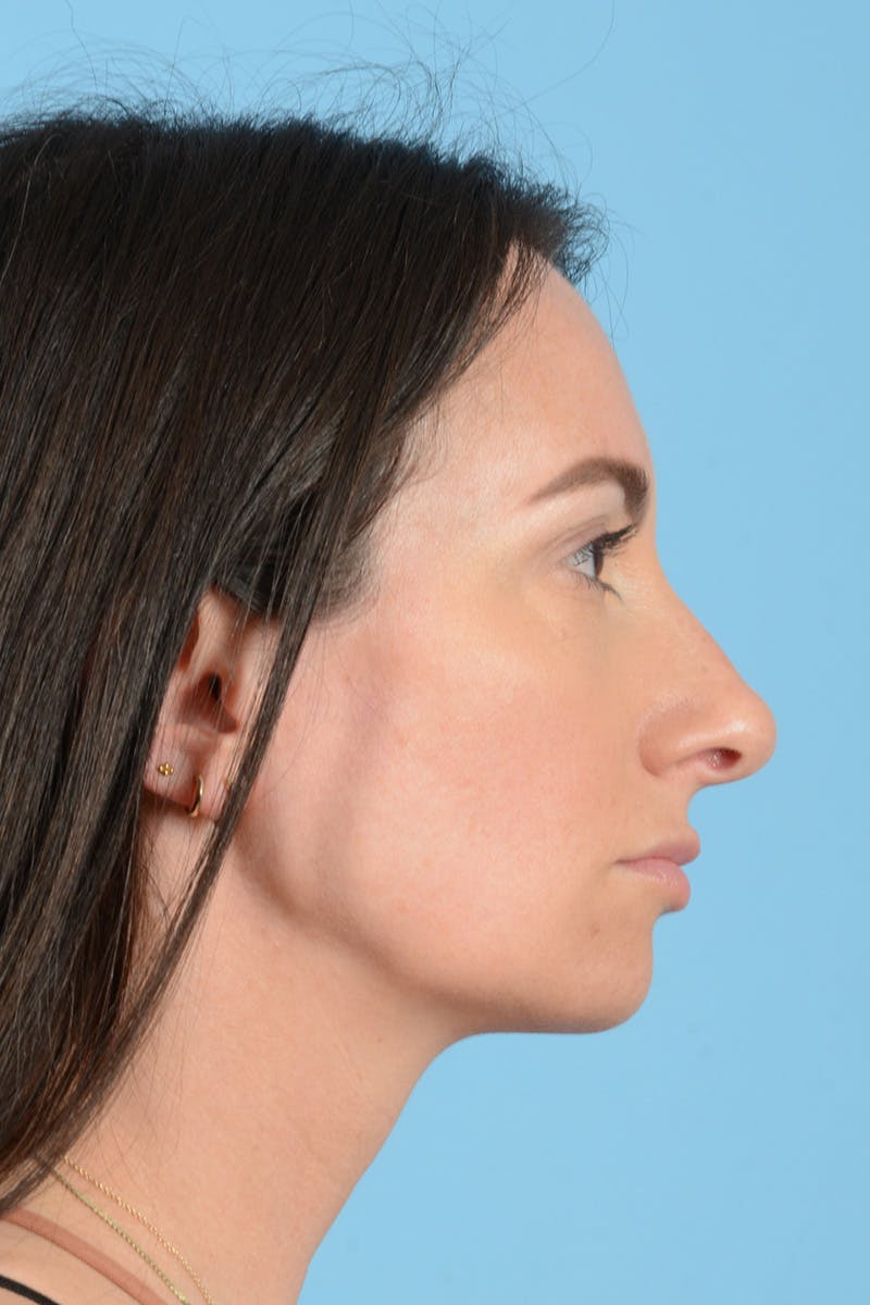 Rhinoplasty Before & After Gallery - Patient 312442 - Image 7