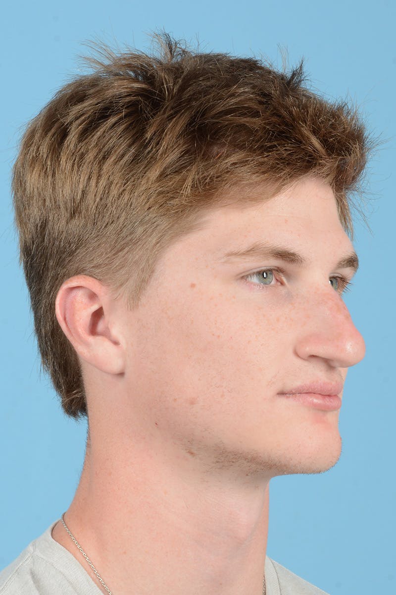 Rhinoplasty Before & After Gallery - Patient 156634 - Image 5
