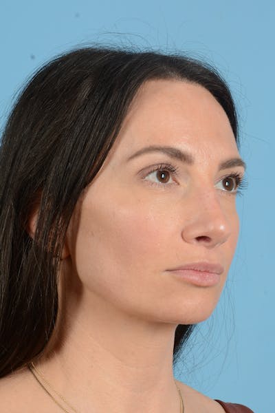 Rhinoplasty Before & After Gallery - Patient 312442 - Image 6