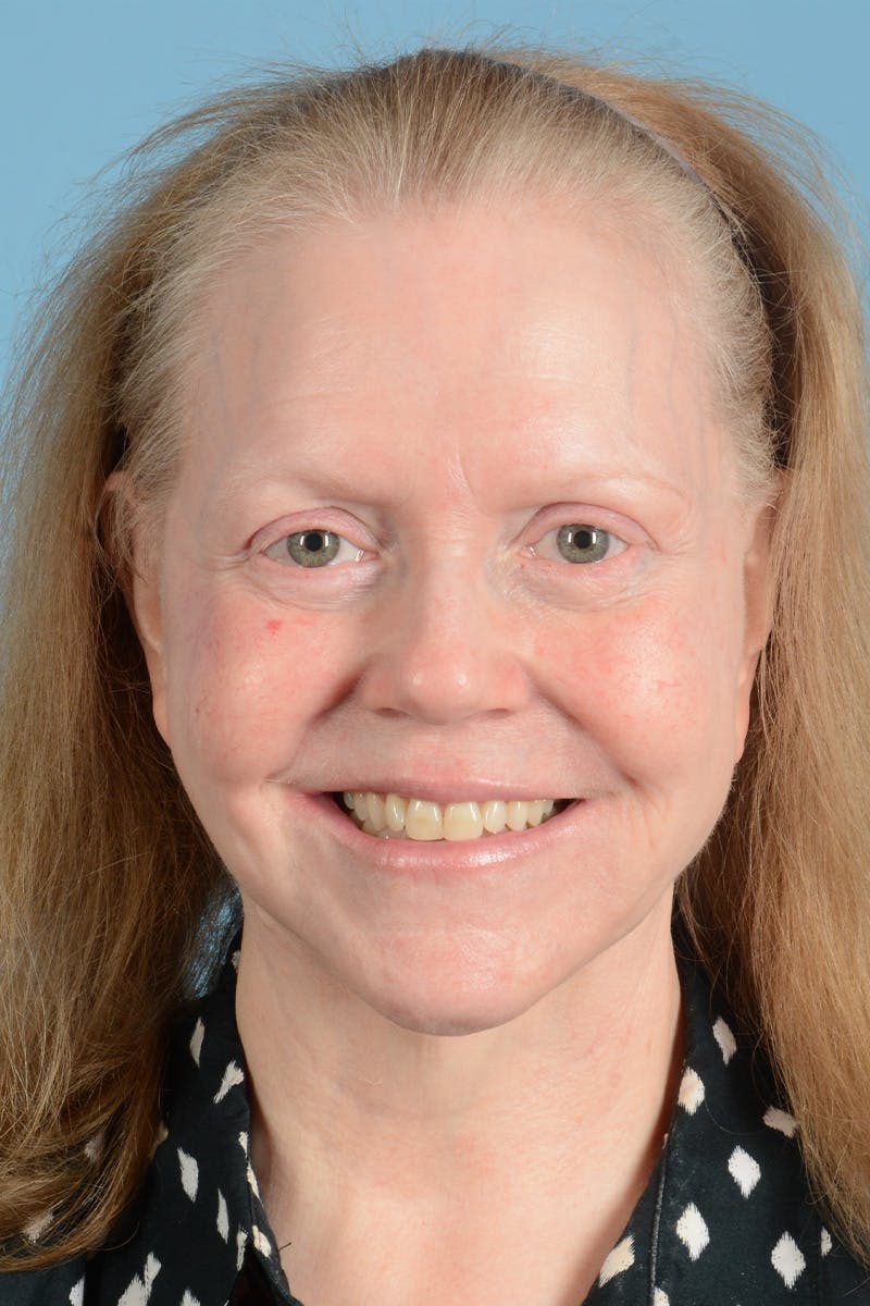 Facelift Before & After Gallery - Patient 422480 - Image 4