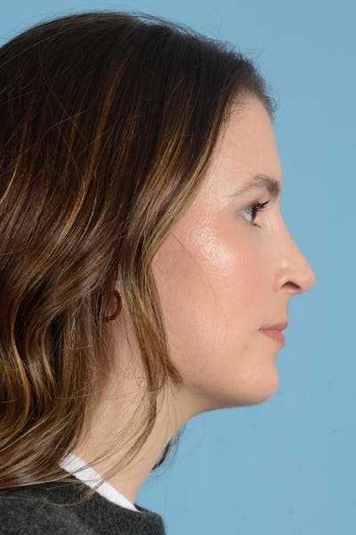 Rhinoplasty Before & After Gallery - Patient 316264 - Image 6