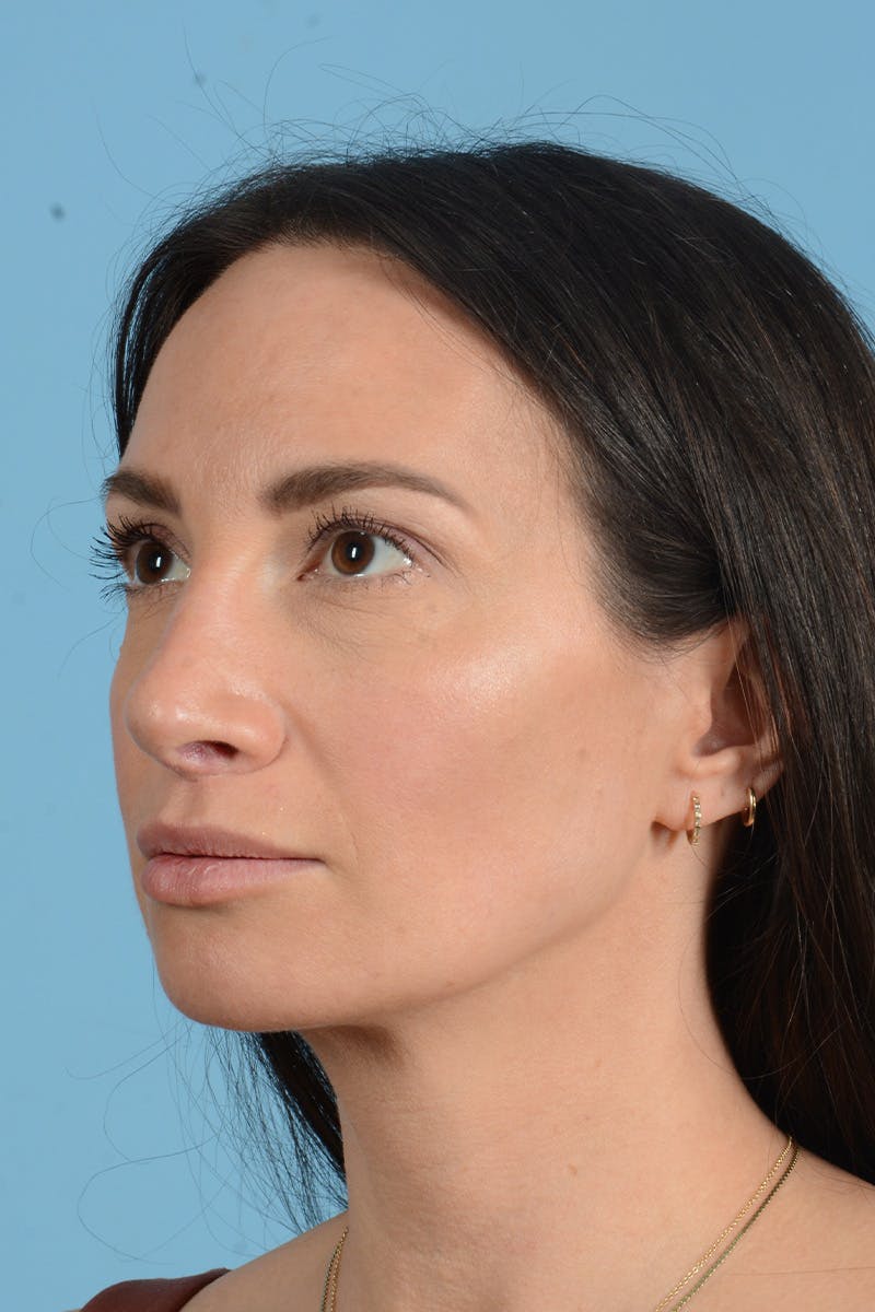 Rhinoplasty Before & After Gallery - Patient 312442 - Image 10