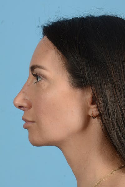 Rhinoplasty Before & After Gallery - Patient 312442 - Image 12