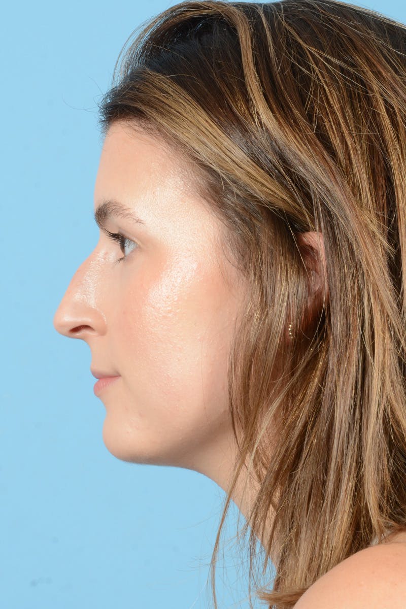 Rhinoplasty Before & After Gallery - Patient 316264 - Image 9