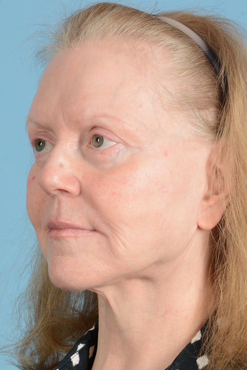 Facelift Before & After Gallery - Patient 422480 - Image 8