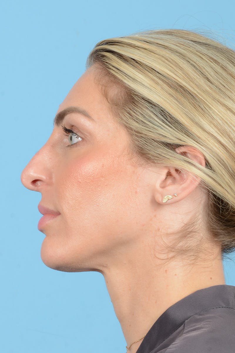 Rhinoplasty Before & After Gallery - Patient 249686 - Image 11