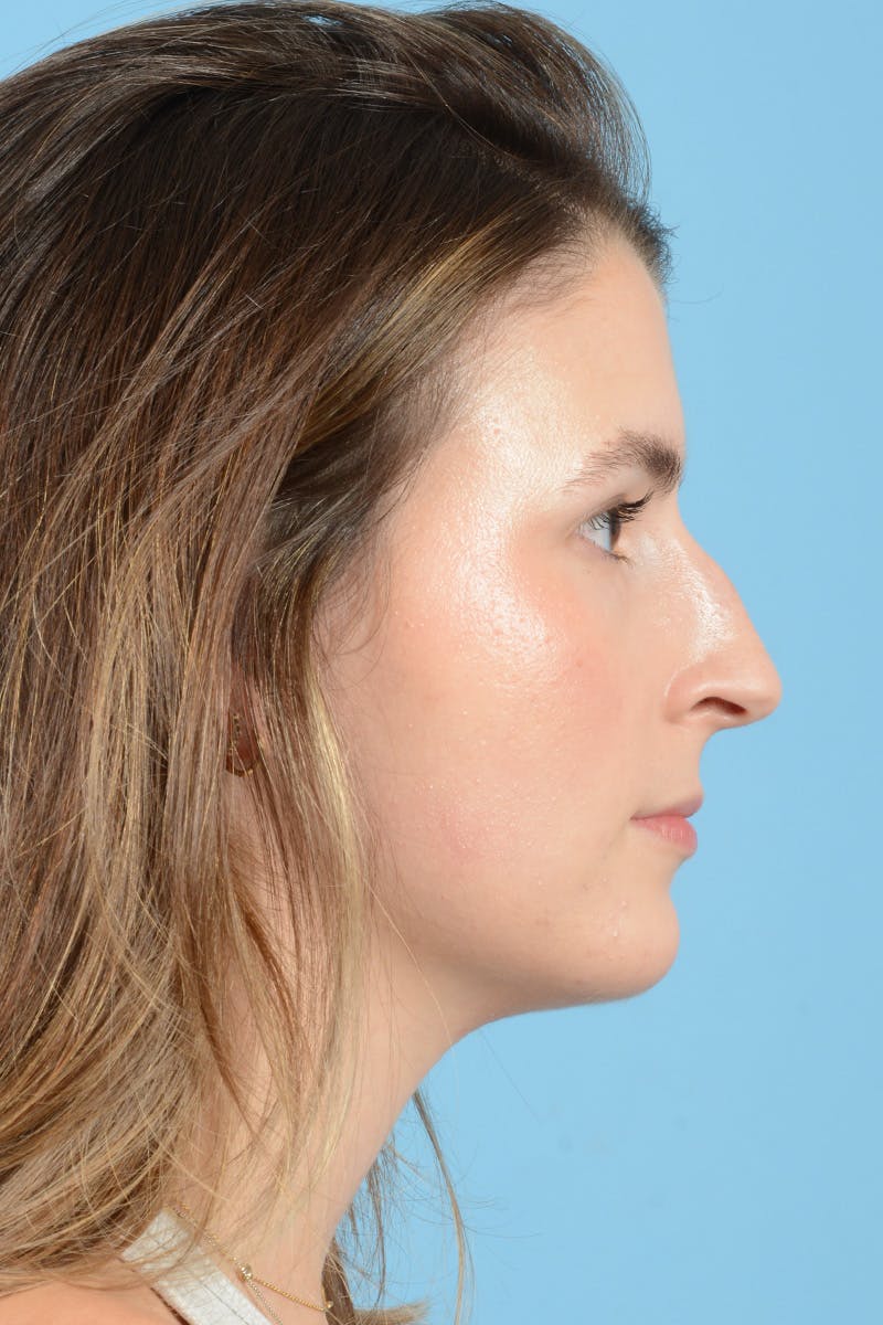 Rhinoplasty Before & After Gallery - Patient 316264 - Image 5