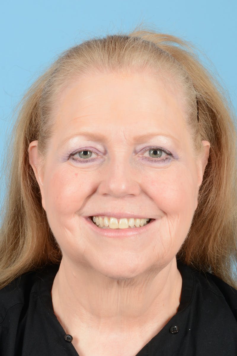 Facelift Before & After Gallery - Patient 422480 - Image 3