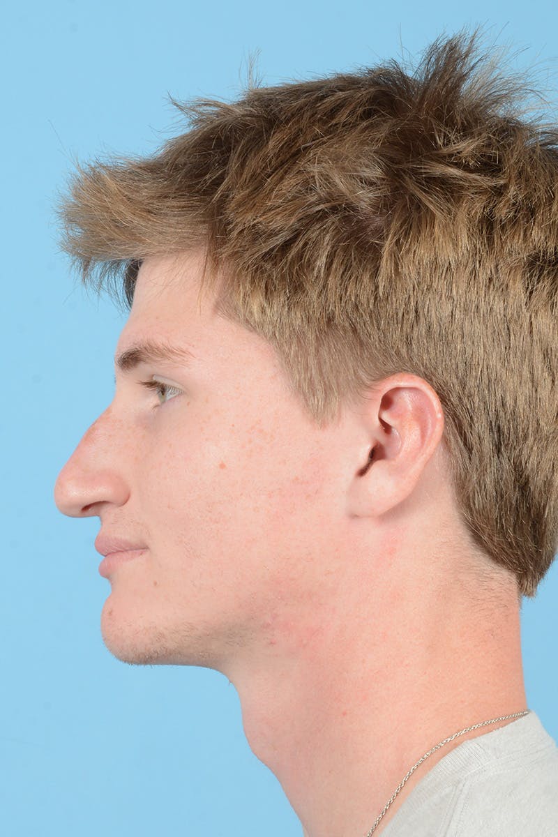 Rhinoplasty Before & After Gallery - Patient 156634 - Image 11