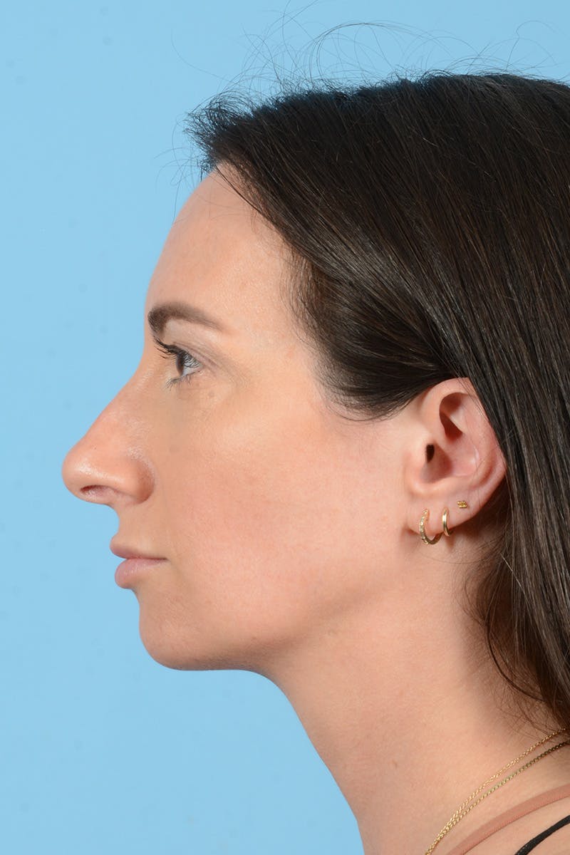 Rhinoplasty Before & After Gallery - Patient 312442 - Image 11