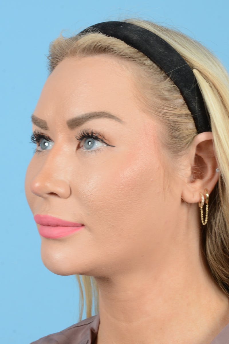 Rhinoplasty Before & After Gallery - Patient 338210 - Image 9