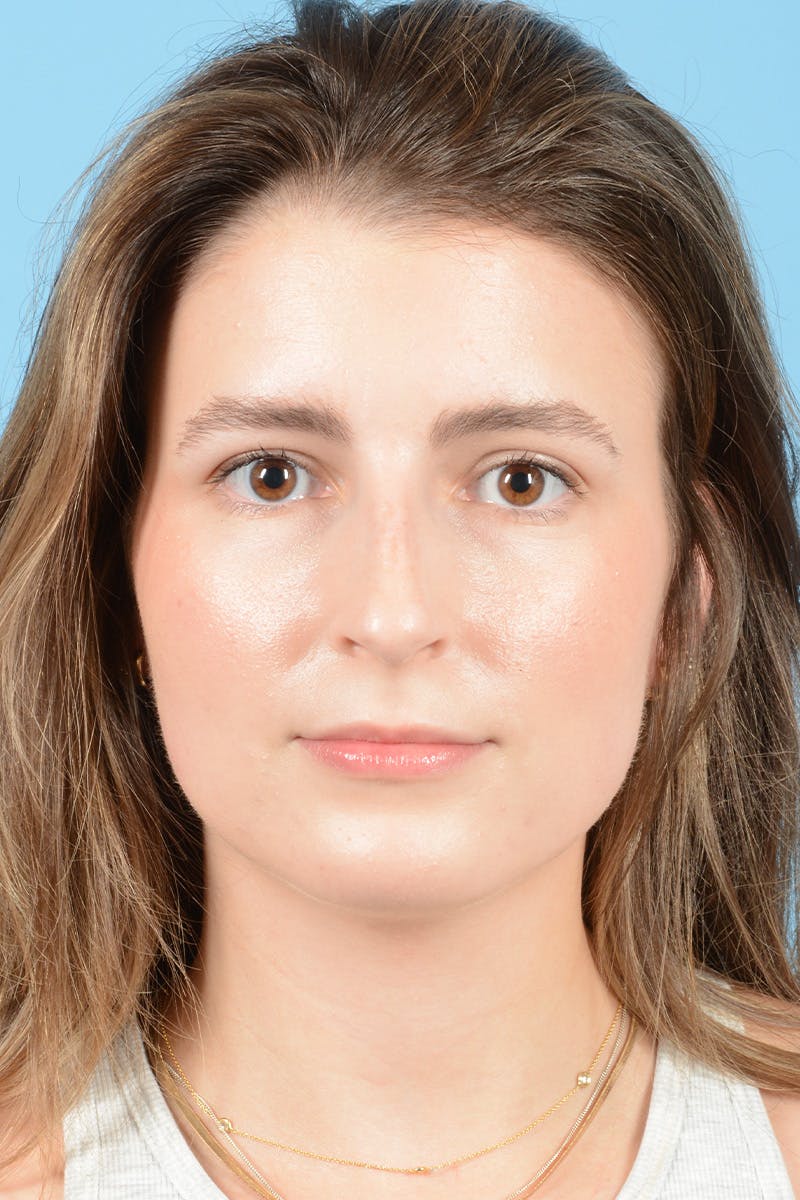 Rhinoplasty Before & After Gallery - Patient 316264 - Image 1