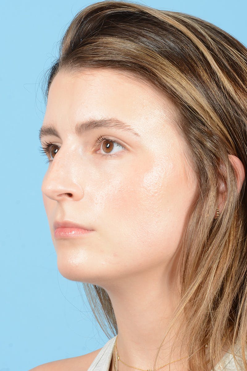 Rhinoplasty Before & After Gallery - Patient 316264 - Image 7