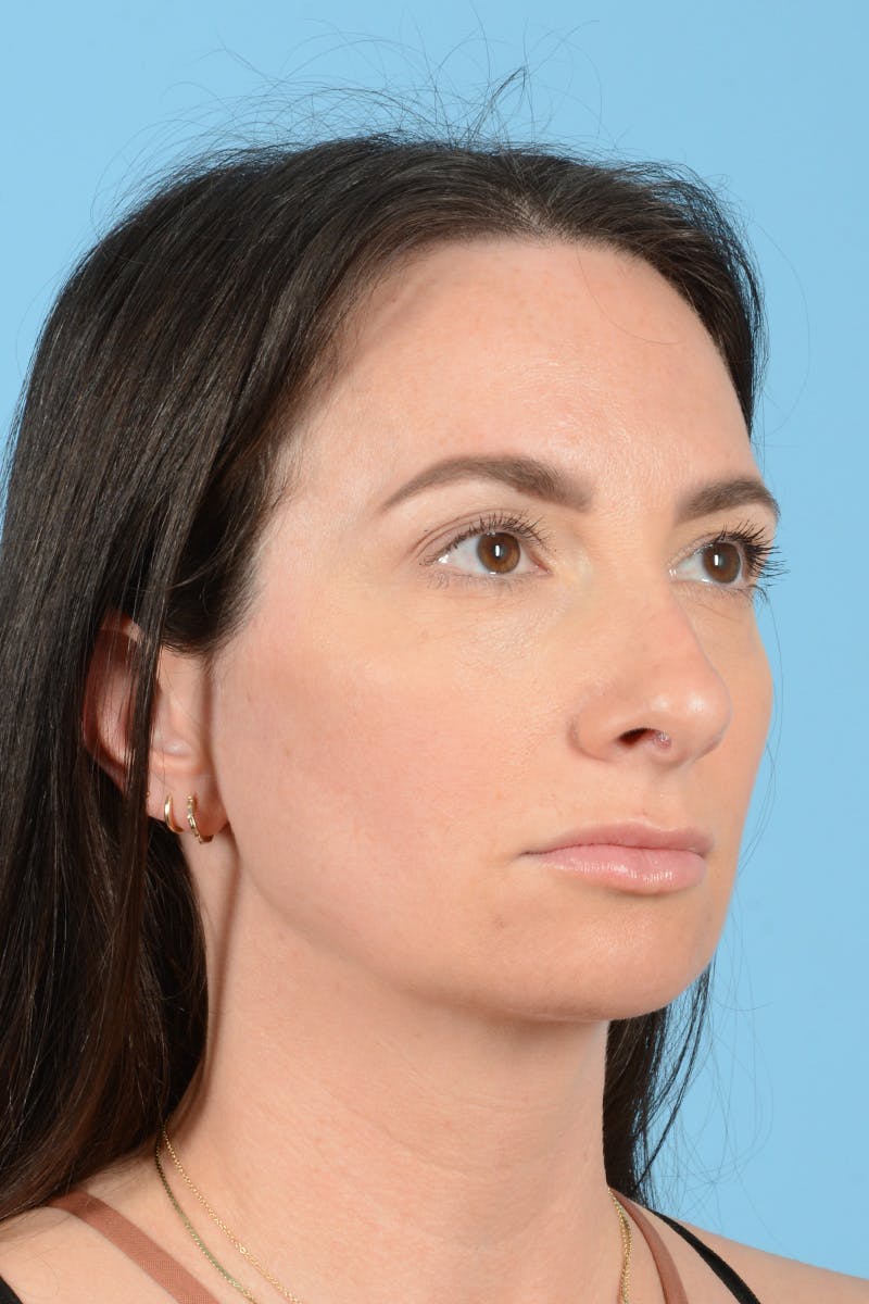 Rhinoplasty Before & After Gallery - Patient 312442 - Image 5