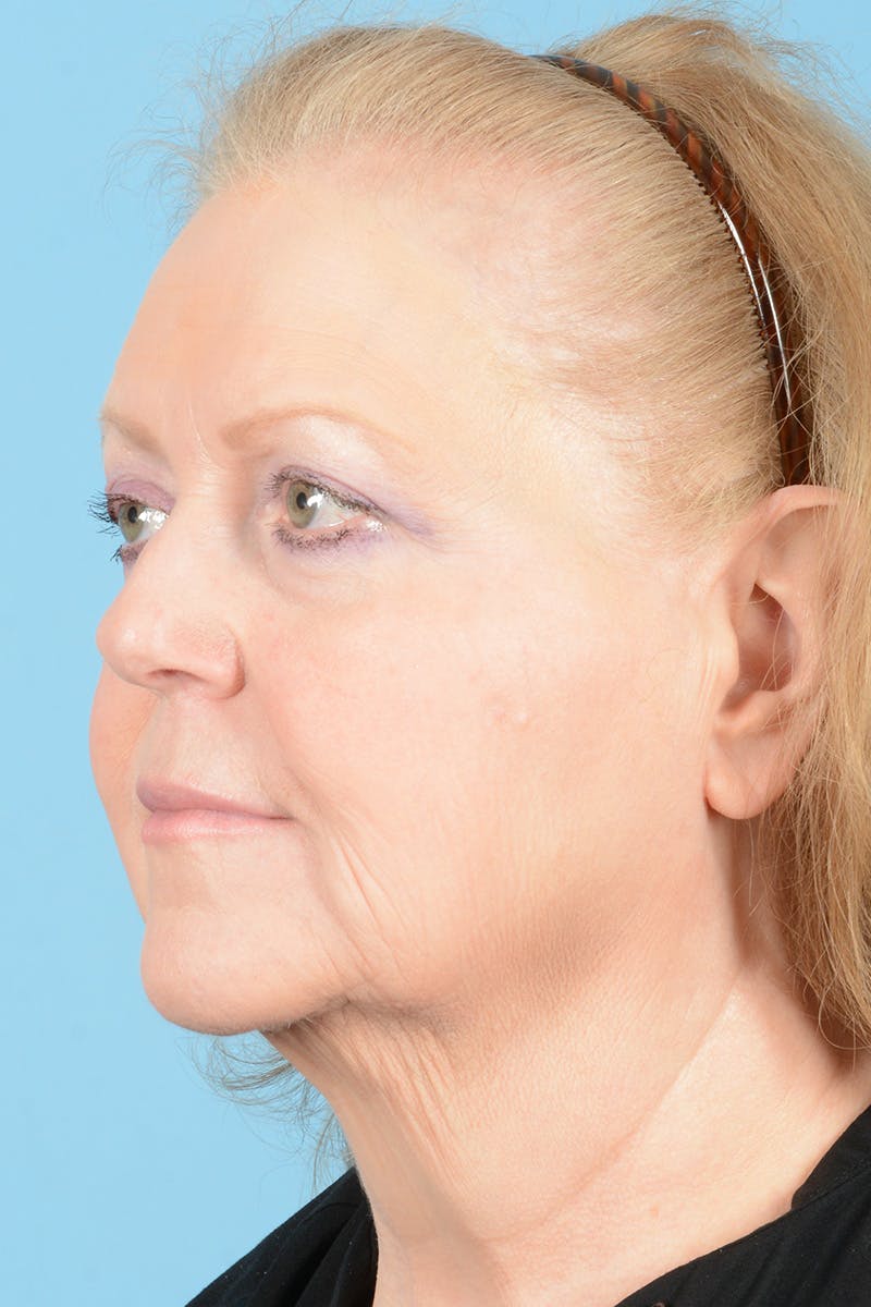 Facelift Before & After Gallery - Patient 422480 - Image 7