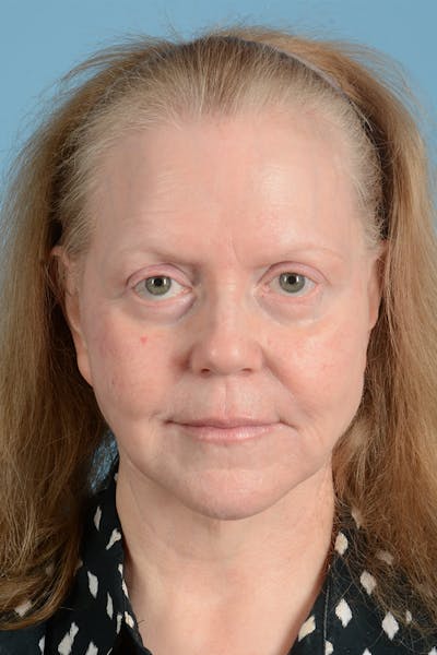 Facelift Before & After Gallery - Patient 422480 - Image 2