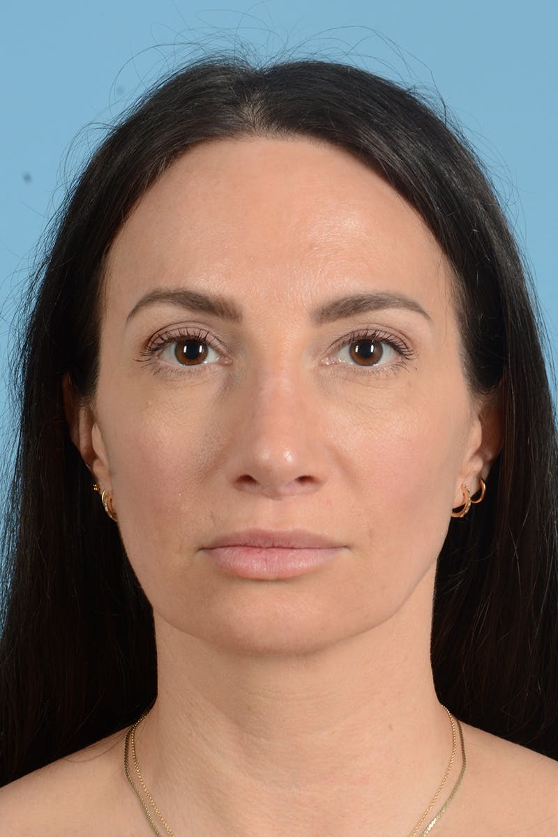 Rhinoplasty Before & After Gallery - Patient 312442 - Image 2