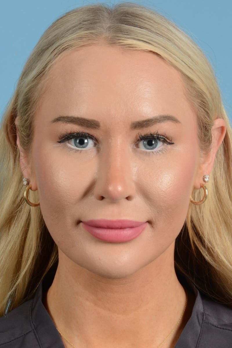 Rhinoplasty Before & After Gallery - Patient 338210 - Image 2