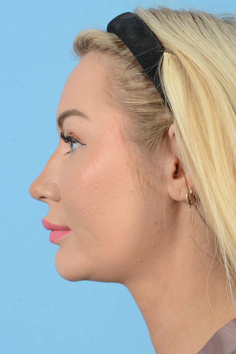 Rhinoplasty Before & After Gallery - Patient 338210 - Image 11