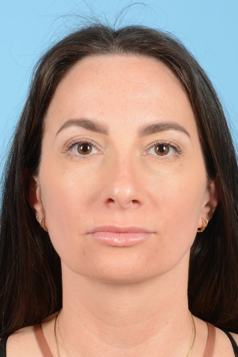 Rhinoplasty Before & After Gallery - Patient 312442 - Image 1