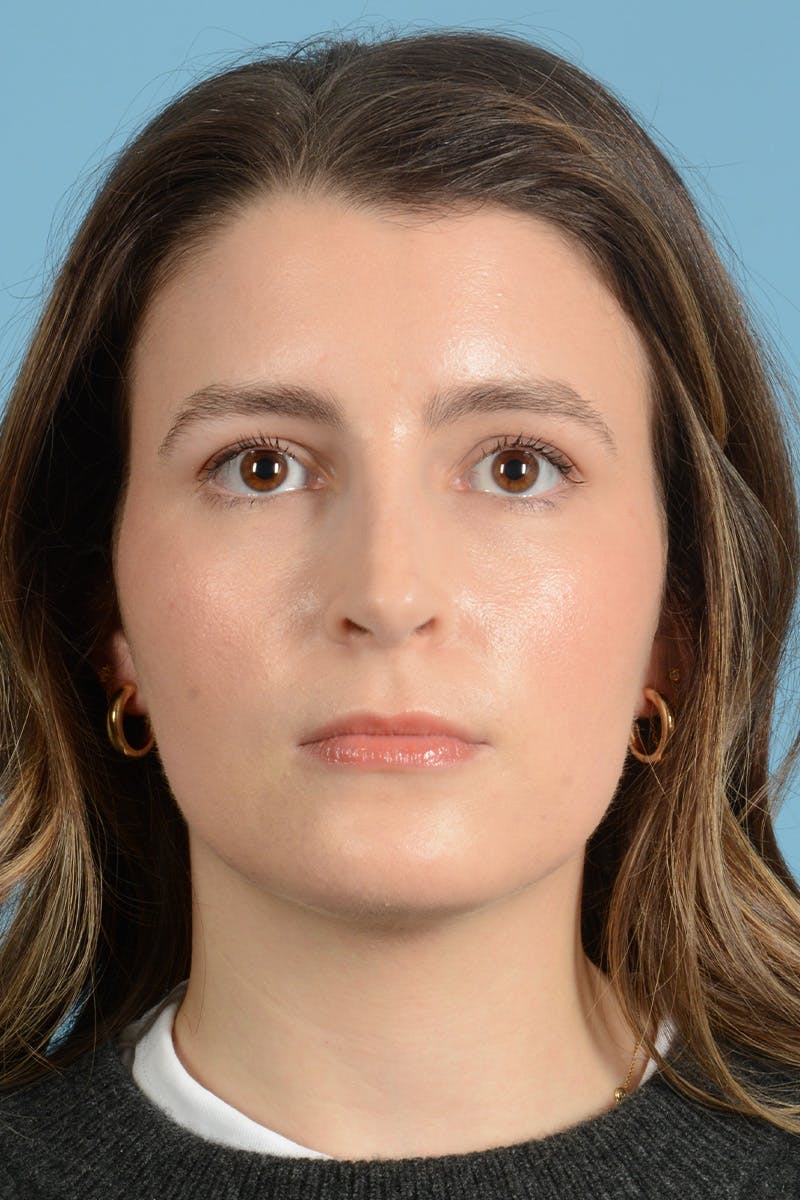 Rhinoplasty Before & After Gallery - Patient 316264 - Image 2