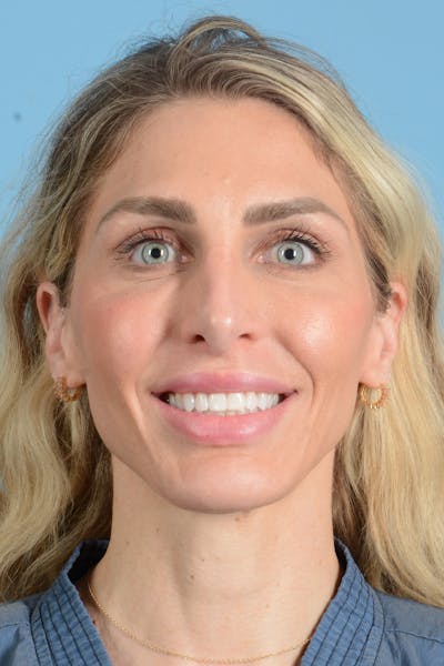 Rhinoplasty Before & After Gallery - Patient 249686 - Image 4