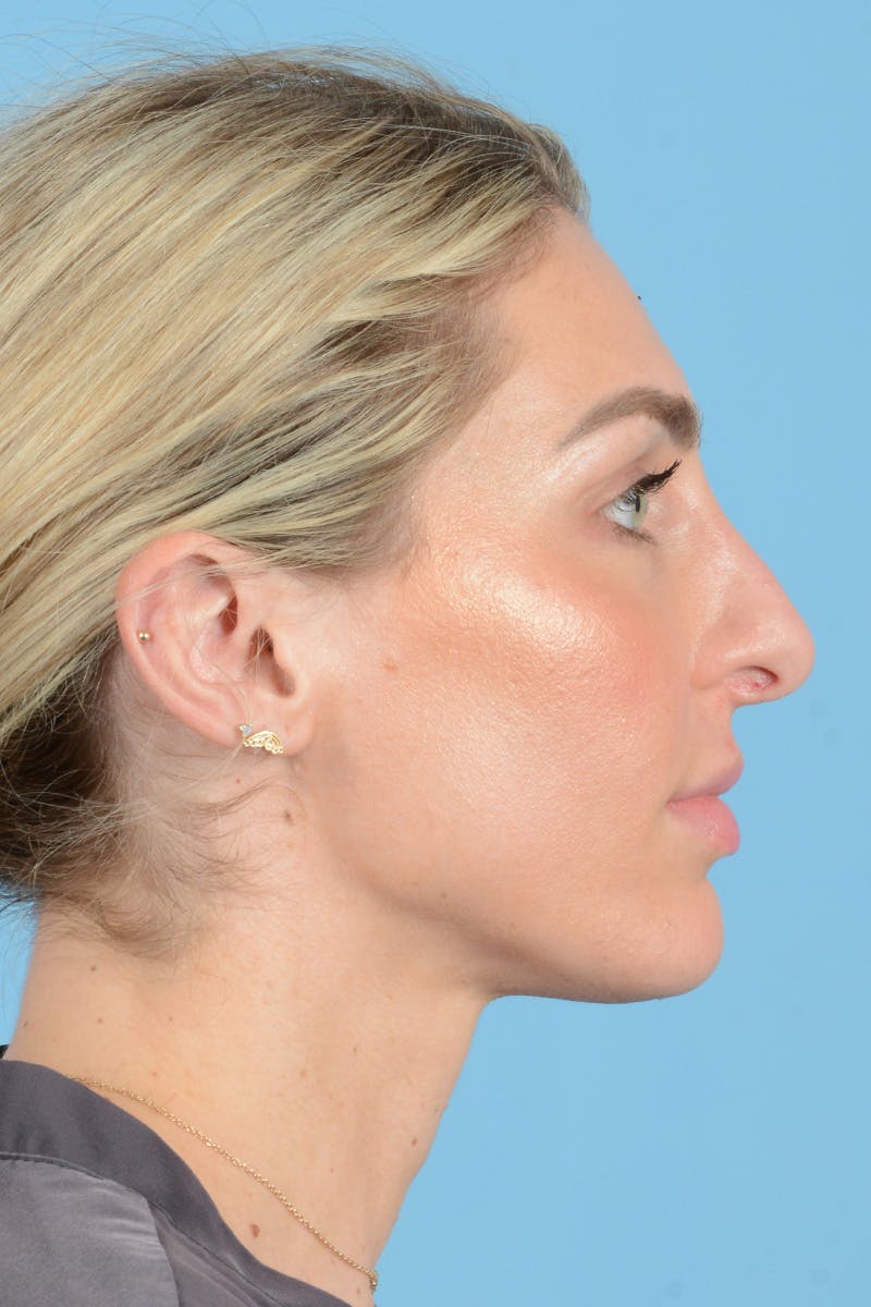 Rhinoplasty Before & After Gallery - Patient 249686 - Image 7