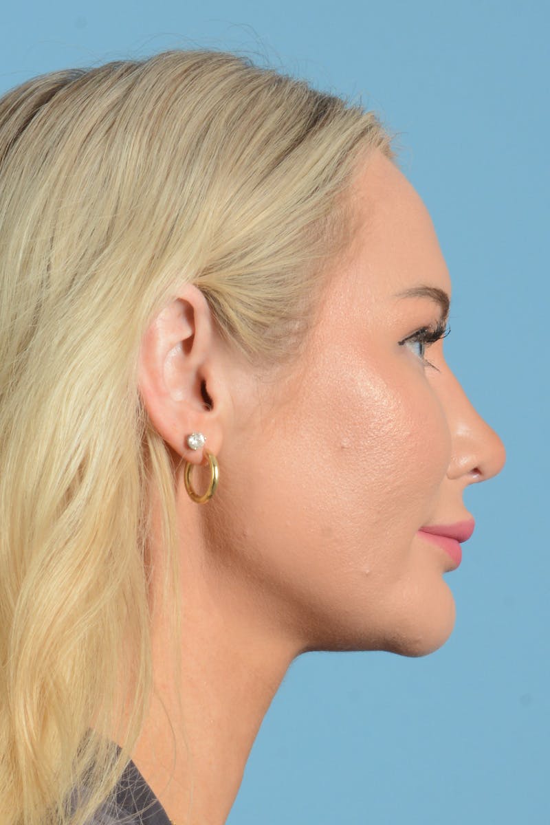Rhinoplasty Before & After Gallery - Patient 338210 - Image 8
