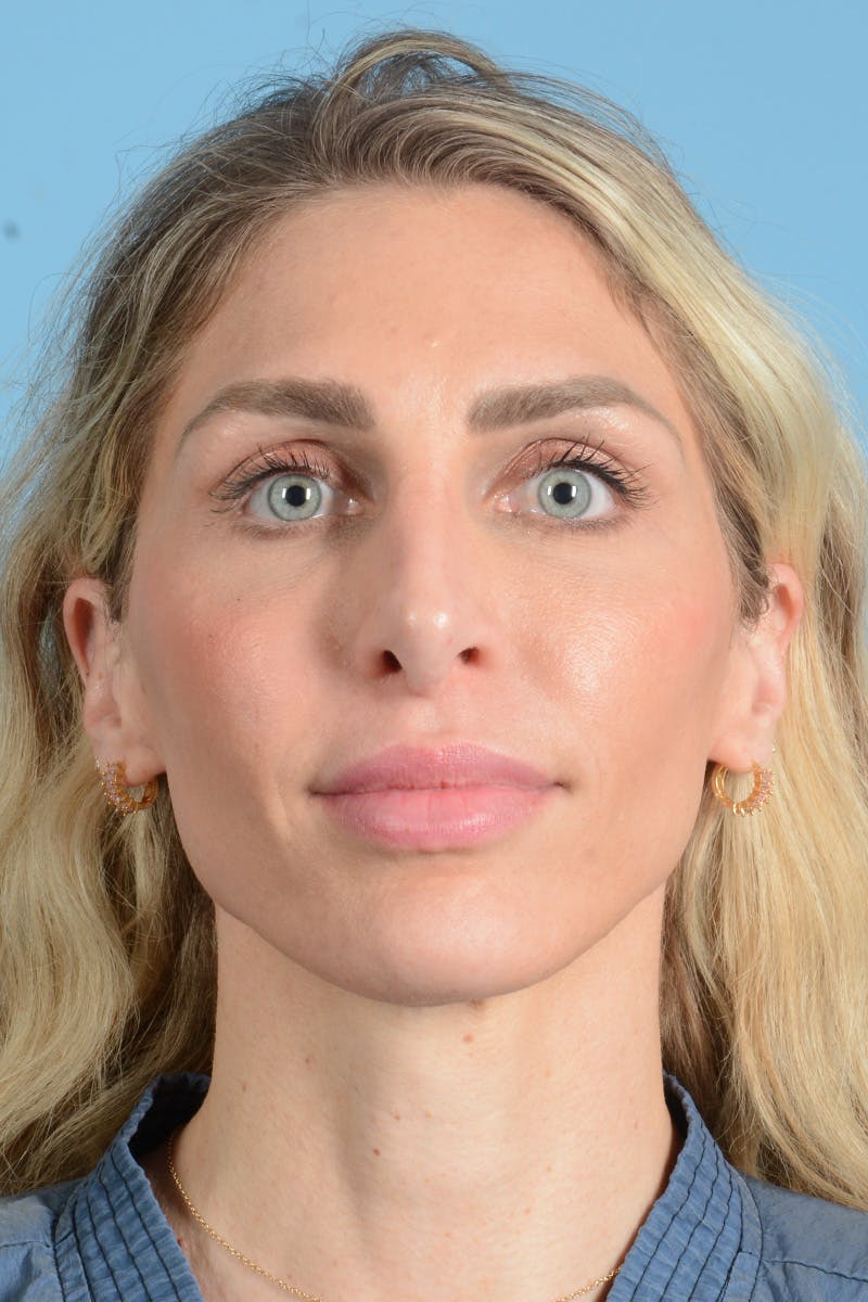 Rhinoplasty Before & After Gallery - Patient 249686 - Image 2