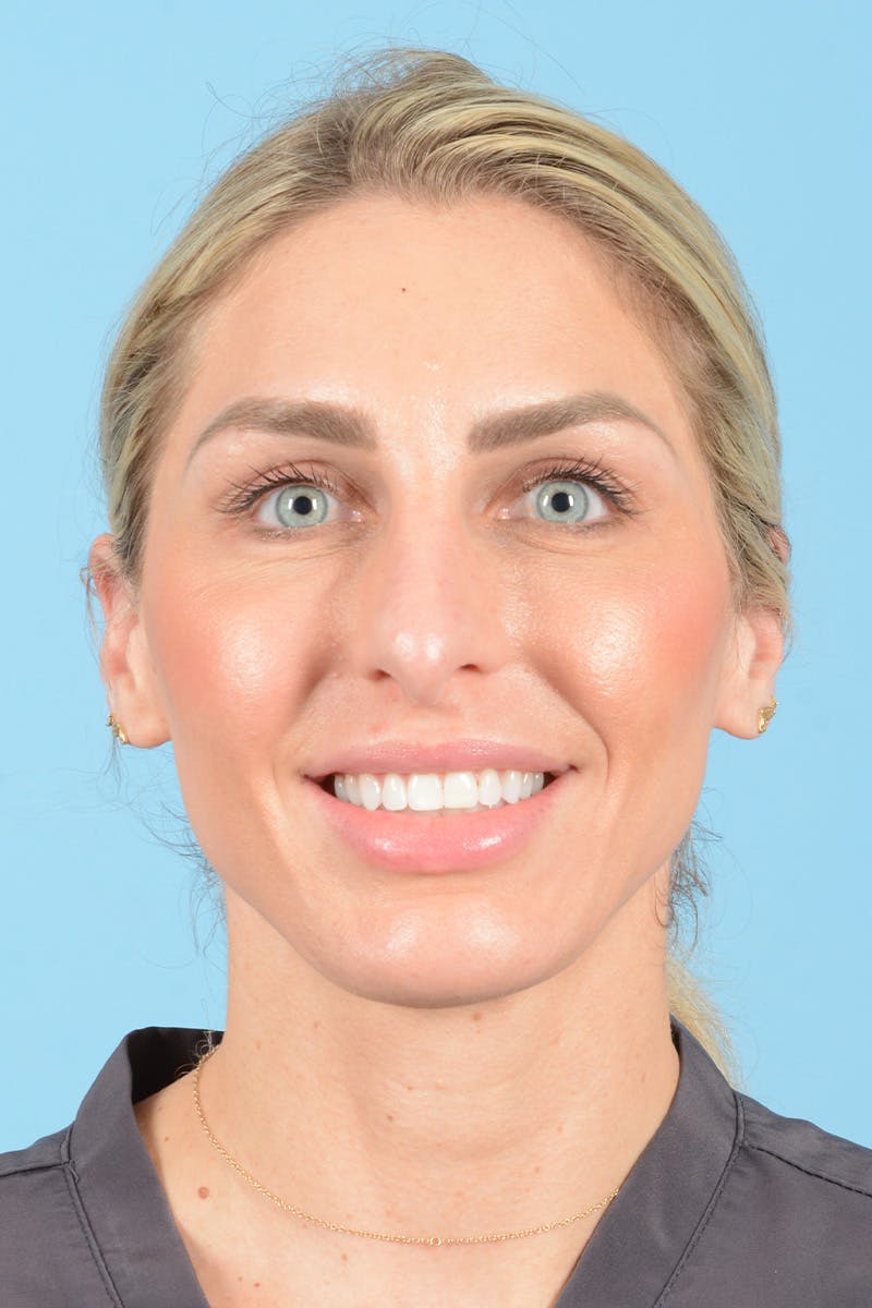Rhinoplasty Before & After Gallery - Patient 249686 - Image 3