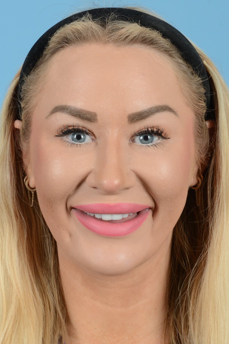 Rhinoplasty Before & After Gallery - Patient 338210 - Image 3