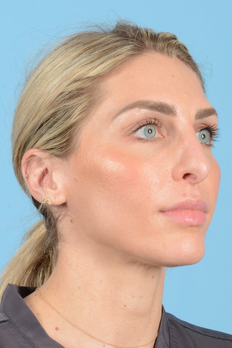 Rhinoplasty Before & After Gallery - Patient 249686 - Image 5