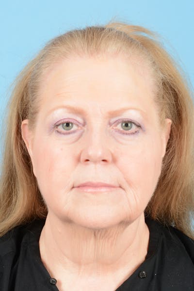 Facelift Before & After Gallery - Patient 422480 - Image 1