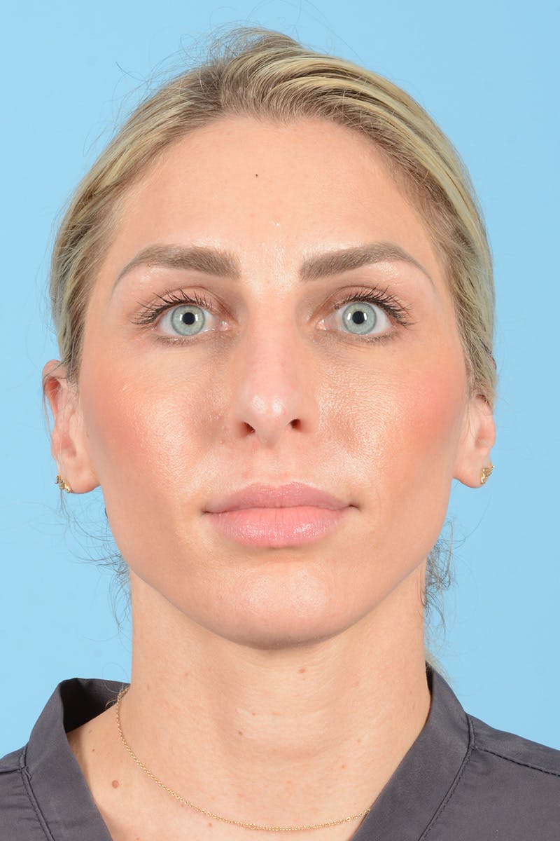 Rhinoplasty Before & After Gallery - Patient 249686 - Image 1