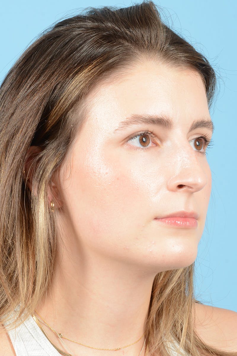 Rhinoplasty Before & After Gallery - Patient 316264 - Image 3