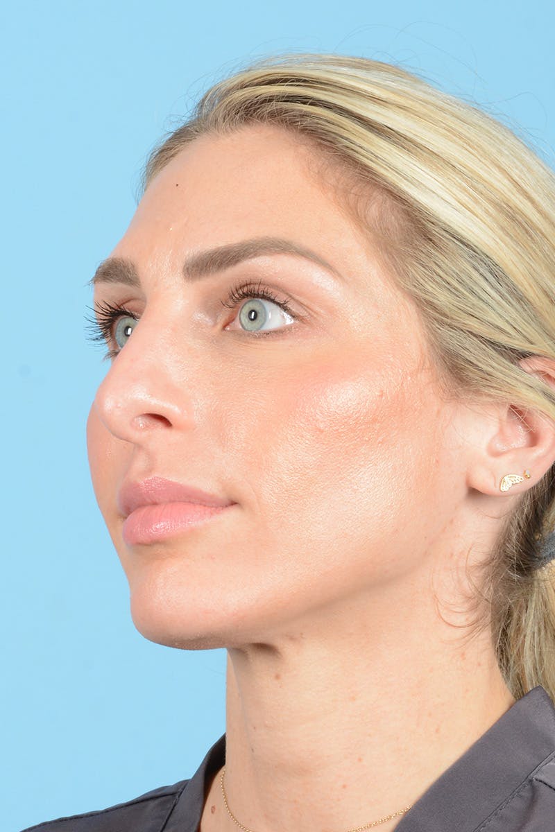 Rhinoplasty Before & After Gallery - Patient 249686 - Image 9
