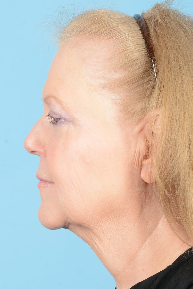 Facelift Before & After Gallery - Patient 422480 - Image 11