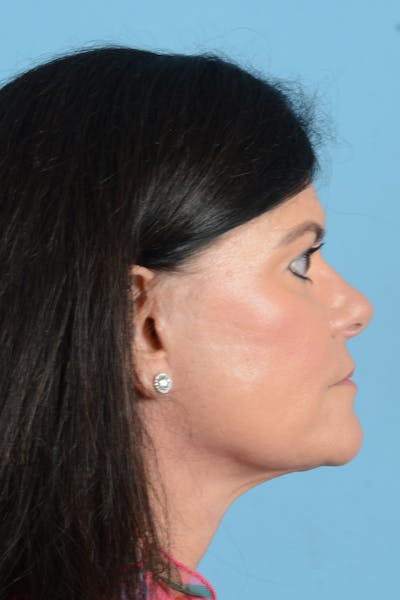 Facelift Before & After Gallery - Patient 214856 - Image 8