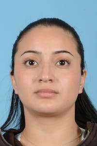 Rhinoplasty Before & After Gallery - Patient 175728 - Image 1