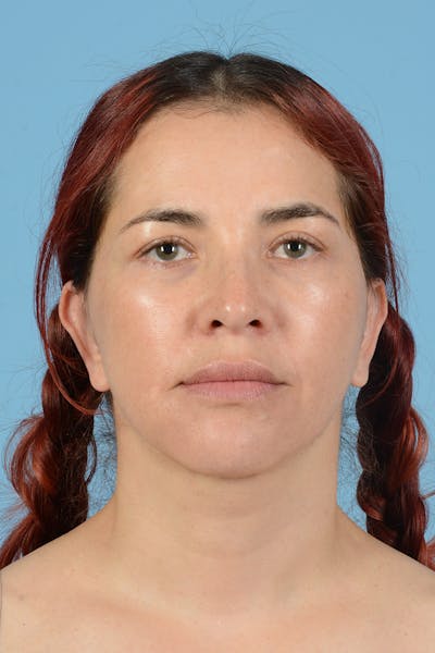 Neck Lift Before & After Gallery - Patient 126947 - Image 2