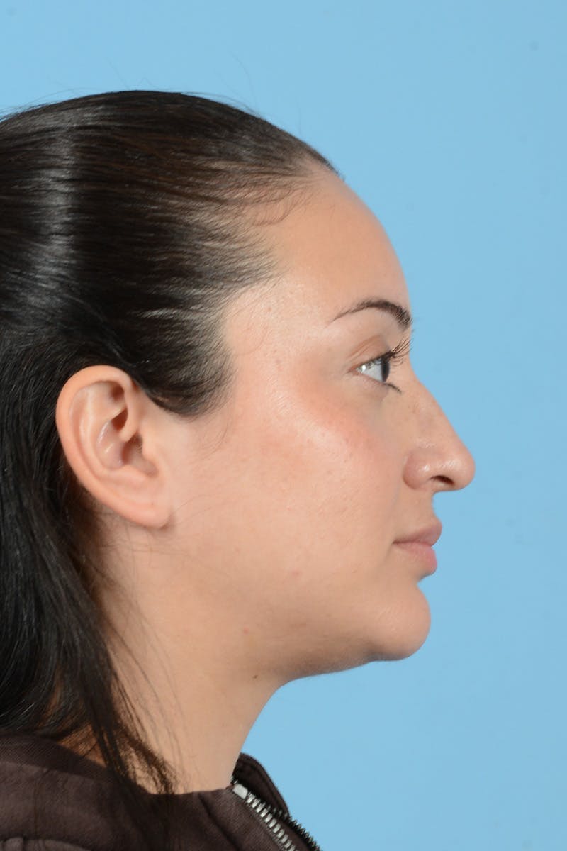 Rhinoplasty Before & After Gallery - Patient 175728 - Image 6