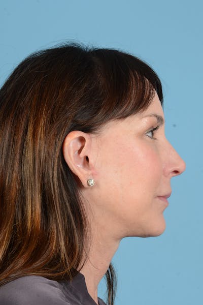 Facial Augmentation Before & After Gallery - Patient 211177 - Image 6