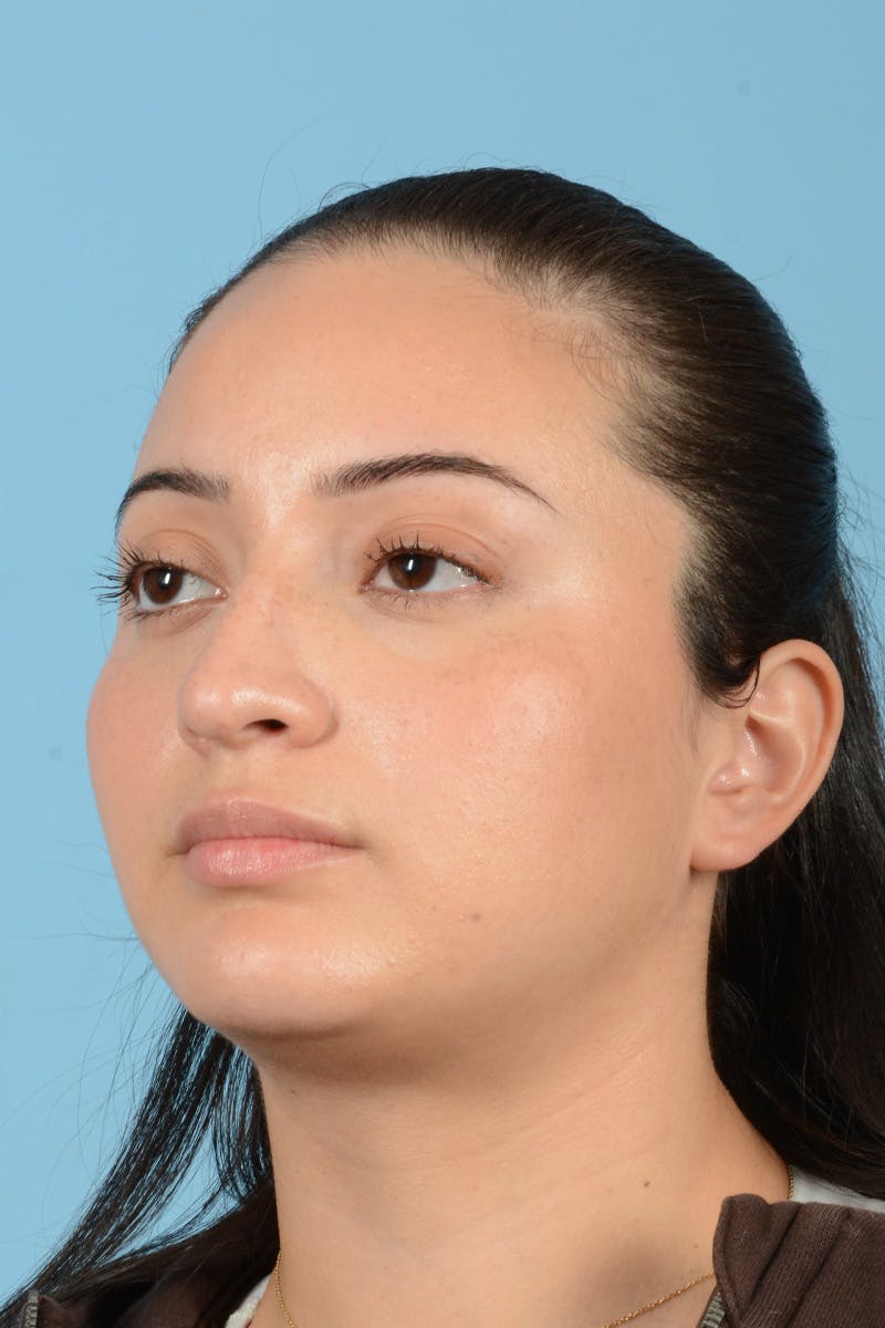 Rhinoplasty Before & After Gallery - Patient 175728 - Image 8