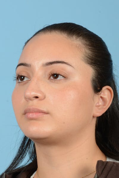 Rhinoplasty Before & After Gallery - Patient 175728 - Image 8