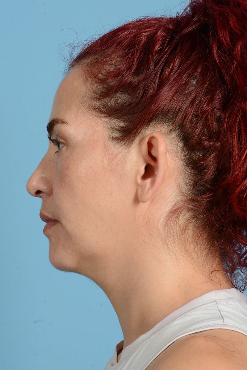 Neck Lift Before & After Gallery - Patient 126947 - Image 9