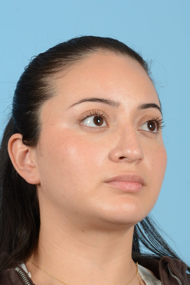 Rhinoplasty Before & After Gallery - Patient 175728 - Image 4
