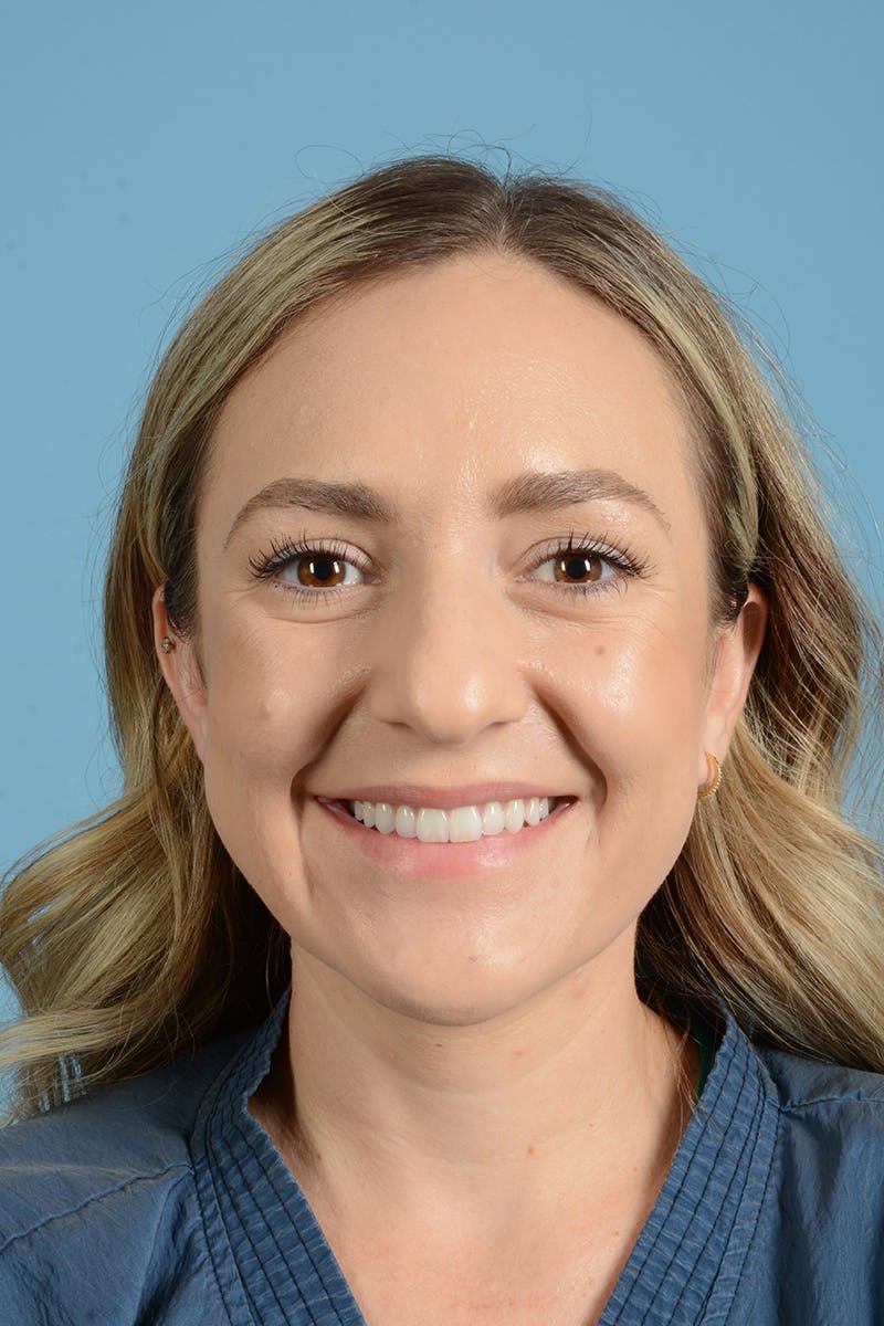 Rhinoplasty Before & After Gallery - Patient 172246 - Image 3