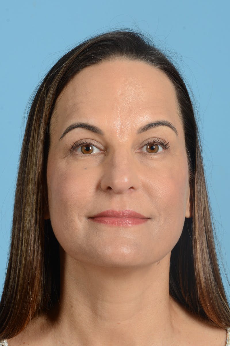 Facial Augmentation Before & After Gallery - Patient 275142 - Image 2